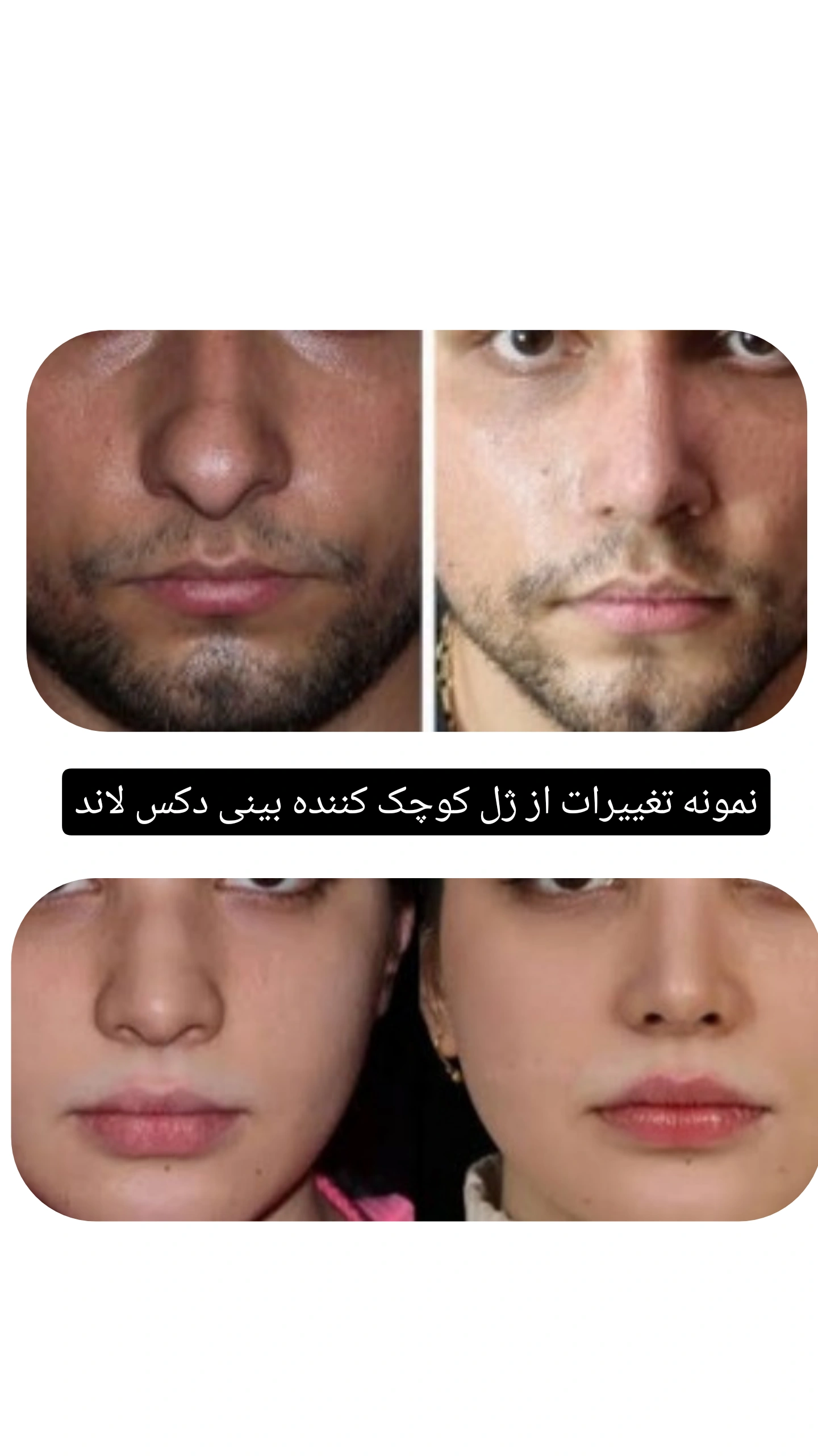 ژل کوچک کننده بینی دکس لاند نمونه اصلی