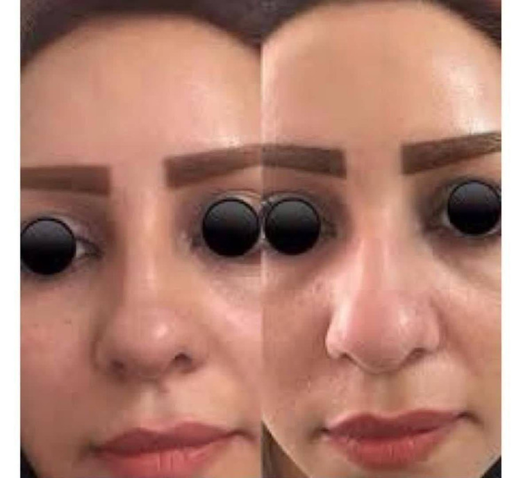 ژل کوچک کننده بینی آگوستا | نمونه اصلی